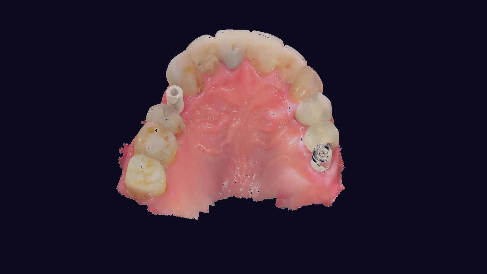 Escaneo intraoral 3D real de una arcada superior con postes de escaneo sobre implantes